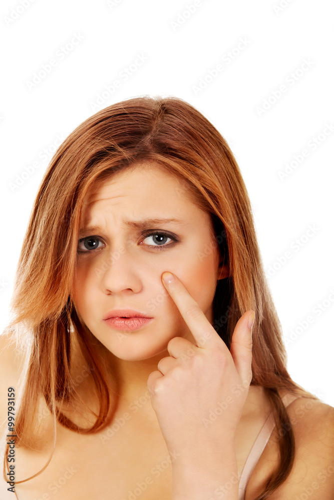 Teenage woman pointing on pimple on her cheek Teenage woman pointing on pimple on her cheek