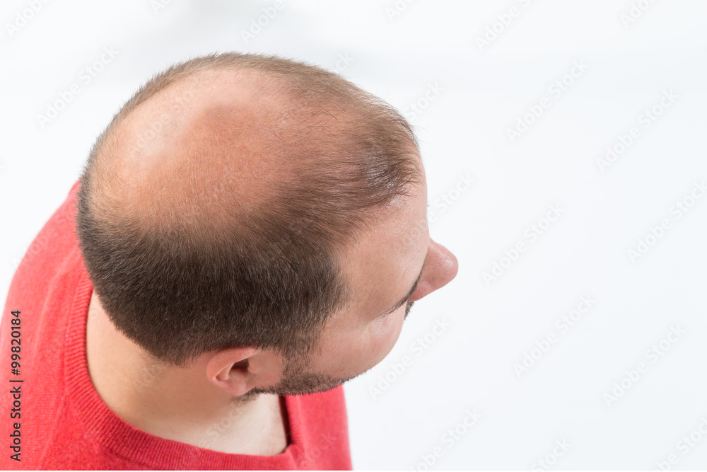 Obraz premium Chutte de Cheveux Homme