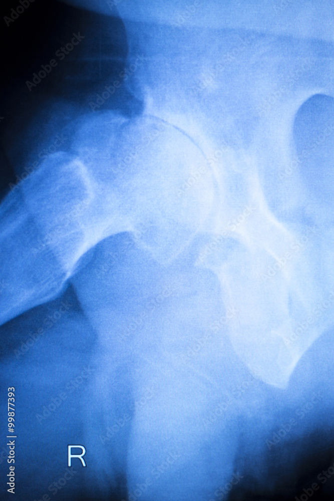 Arthritic hip xray test scan results Arthritic hip xray test scan results