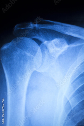 Shoulder injury orthopedics xray scan