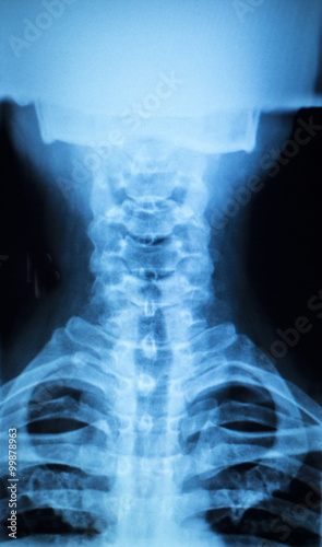 Kneck and spine injury x-ray scan photo