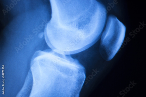 Photography Knee joint meniscus x-ray test scan