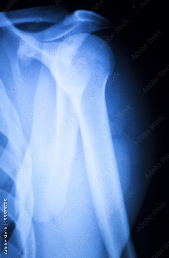 Shoulder injury orthopedics xray scan Shoulder injury orthopedics xray scan