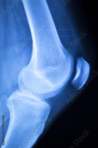 Photography Knee joint meniscus x-ray test scan