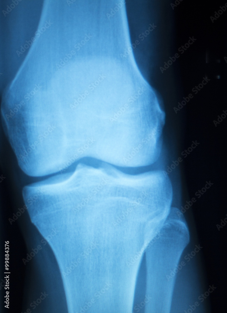 Knee joint meniscus x-ray test scan