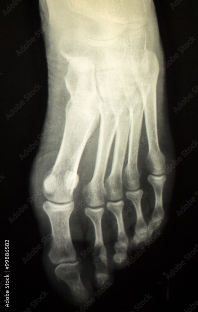 Foot and toes injury x-ray scan