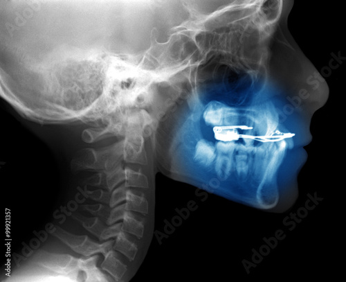 x-ray with fixed appliance used for orthodontic treatment