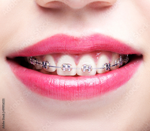 Closeup of woman open smiling mouth with brackets