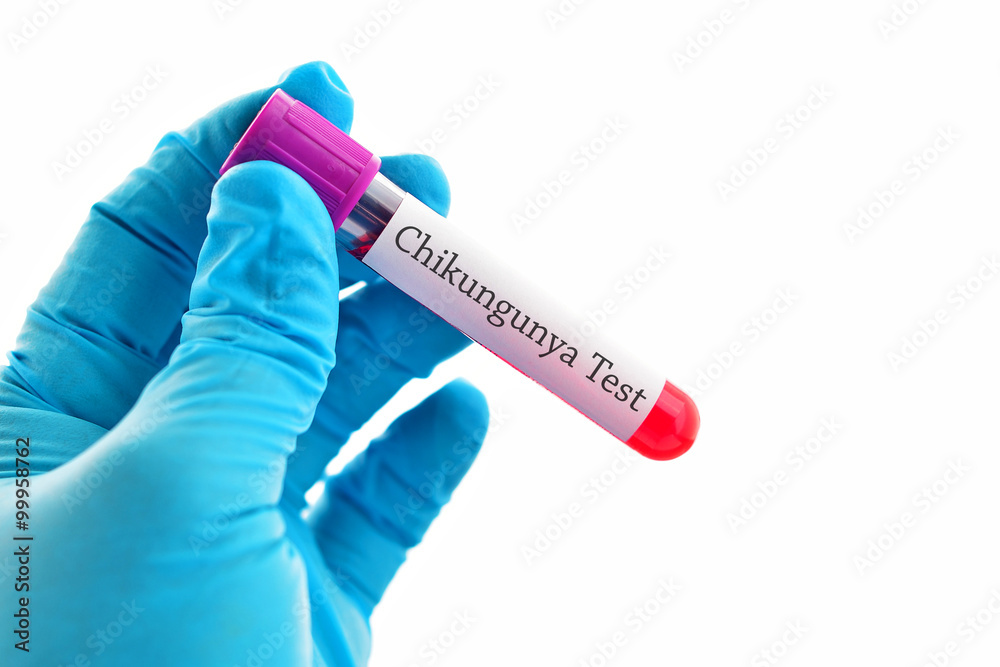 Obraz premium Blood sample for Chikungunya virus test