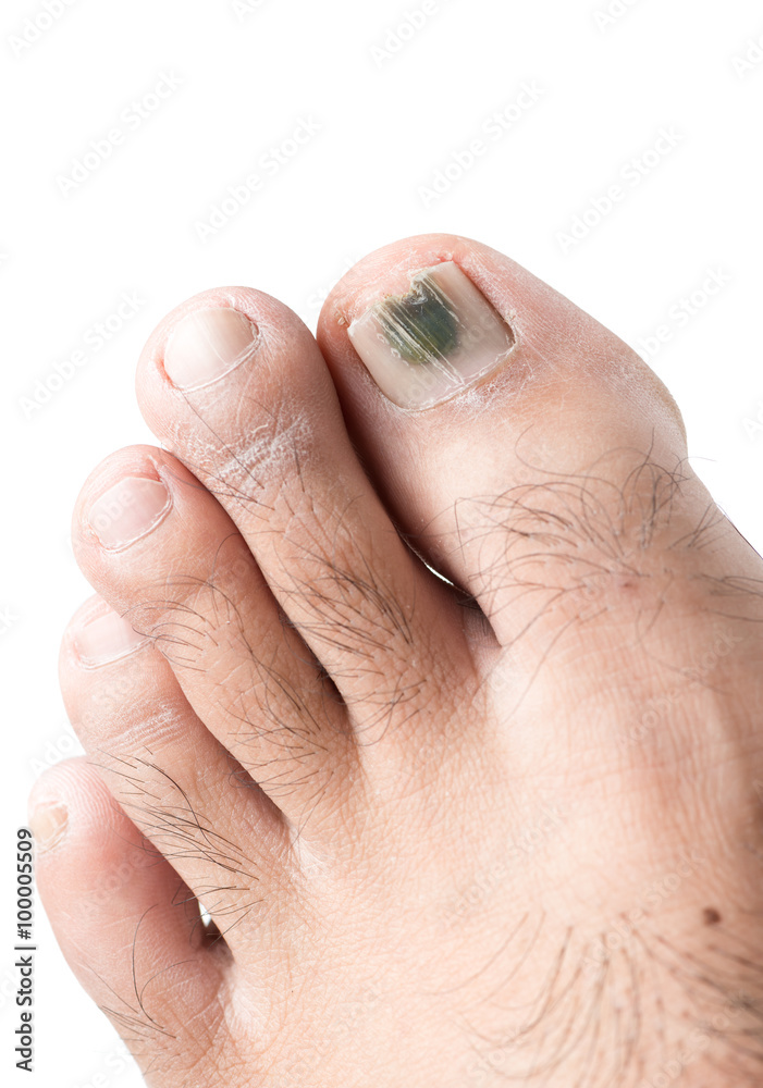 Fotografie fungi on toenail isolated