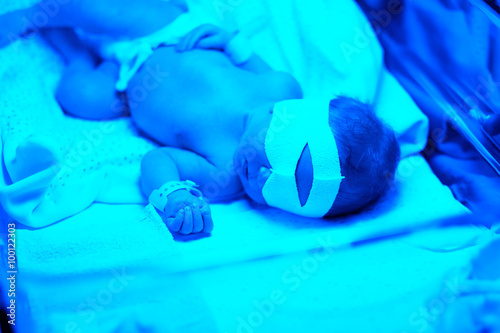 Newborn baby having photo theraphy