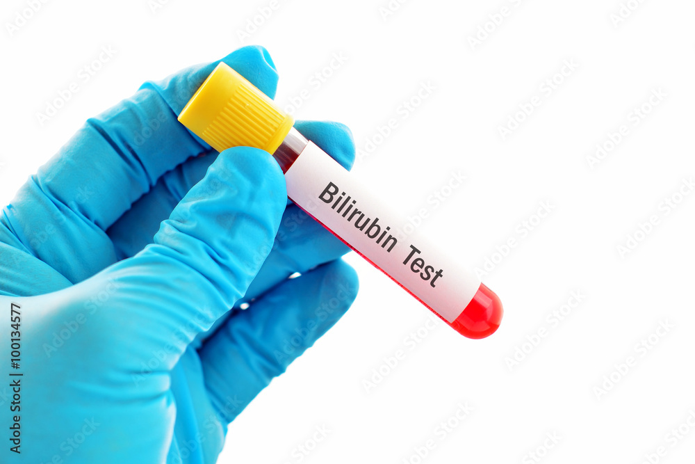 Obraz premium Blood for bilirubin test