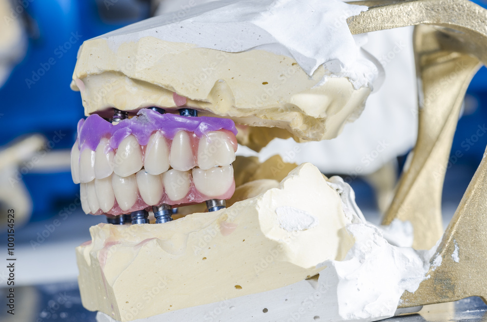 Dental prosthesis porcelain teeth. Stock Photo Adobe Stock