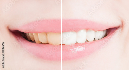 Whiten teeth after bleaching or whitening