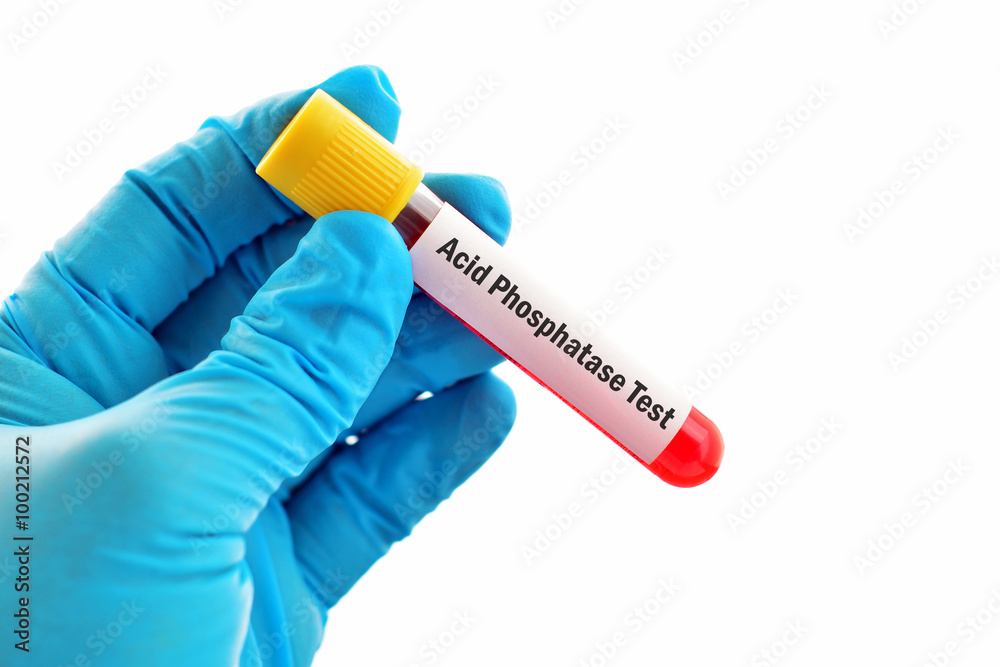 Obraz premium Blood sample for acid phosphatase test