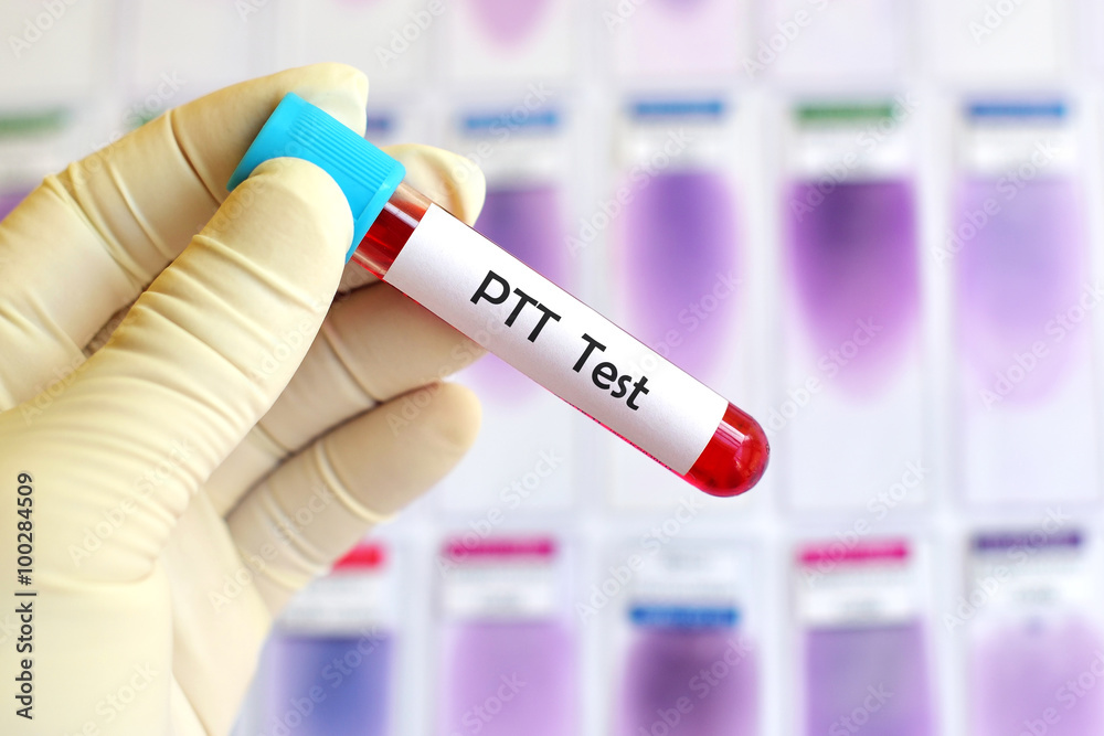 Foto de Blood sample for PTT test (Blood coagulation testing) do Stock ...