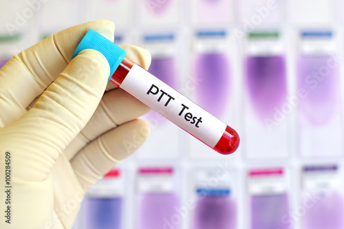 Blood sample for PTT test (Blood coagulation testing)
 photo