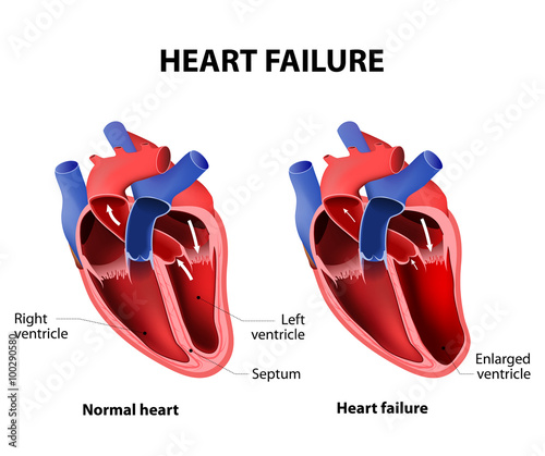 Heart failure