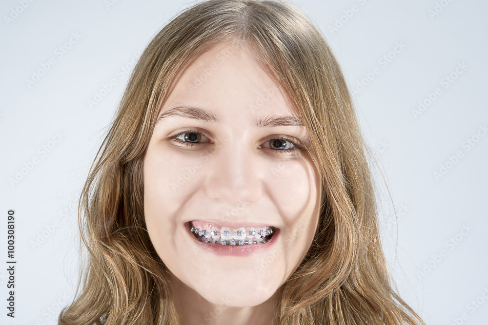 Caucasian Teenage Girl Showing Her Teeth Brackets Caucasian Teenage Girl Showing Her Teeth Brackets
