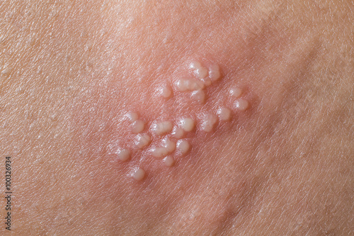 Herpes on the human body