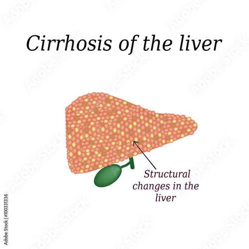 Cirrhosis of the liver. Vector illustration on isolated background photo