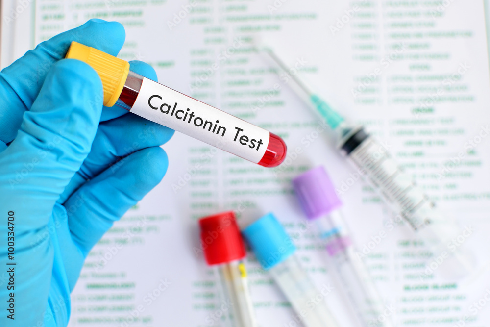 Blood sample for calcitonin test
