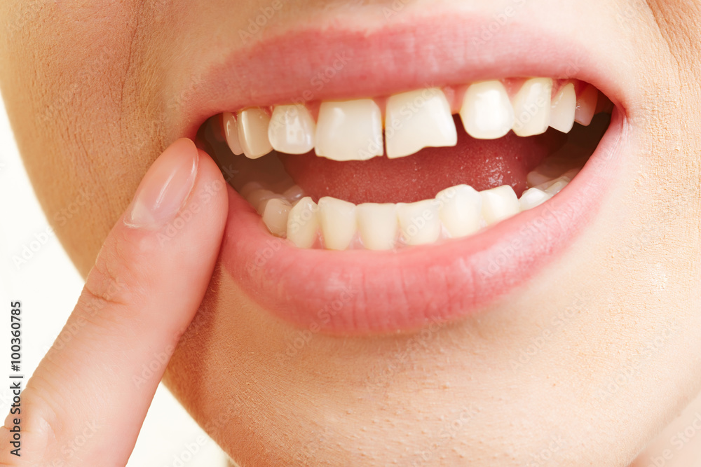 Woman with inflammation of gums Woman with inflammation of gums