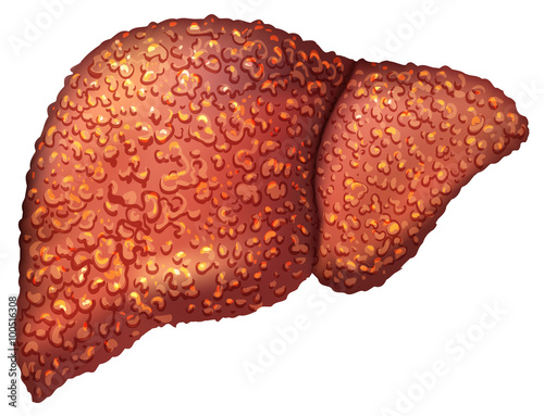 Liver patients with hepatitis. Liver is sick person. Cirrhosis of liver. Repercussion alcoholism photo