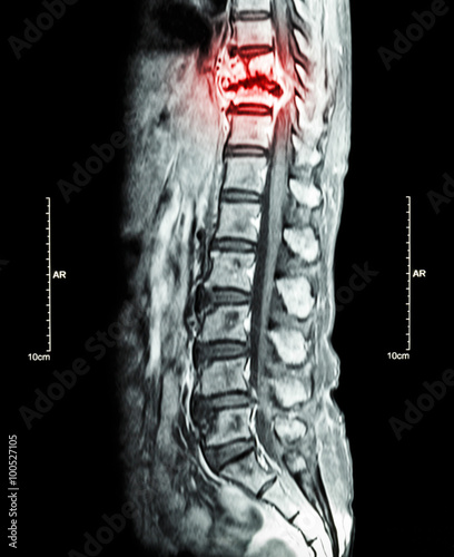 Obraz na plátně Spine metastasis ( cancer spread to thoracic spine ) ( MRI of thoracic and lumba