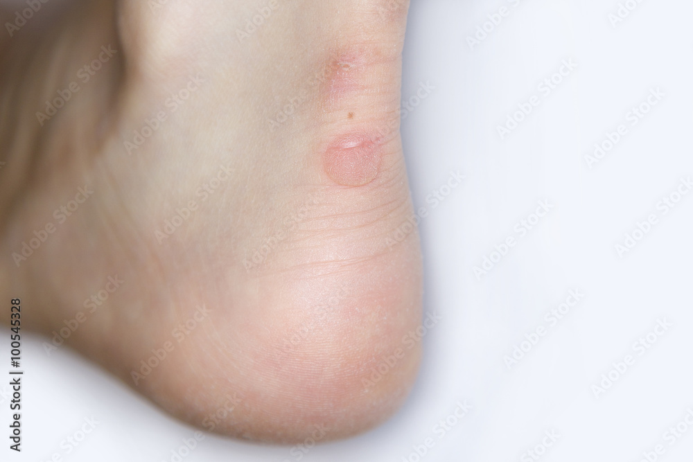 Naklejka premium Blase an der Ferse einer Frau
