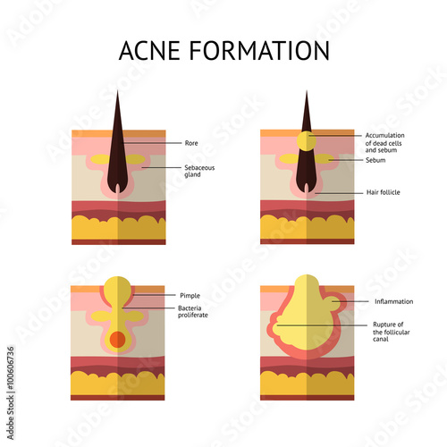 Formation of skin acne or pimple. The sebum in the clogged pore promotes the growth of a certain bacteria. Propionibacterium Acnes. This leads to the redness and inflammation associated with pimples.