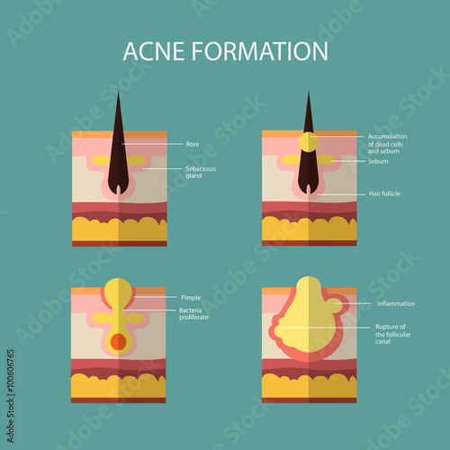 Formation of skin acne or pimple. The sebum in the clogged pore promotes the growth of a certain bacteria. Propionibacterium Acnes. This leads to the redness and inflammation associated with pimples.