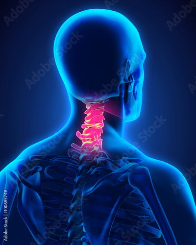 Painful Cervical Spine