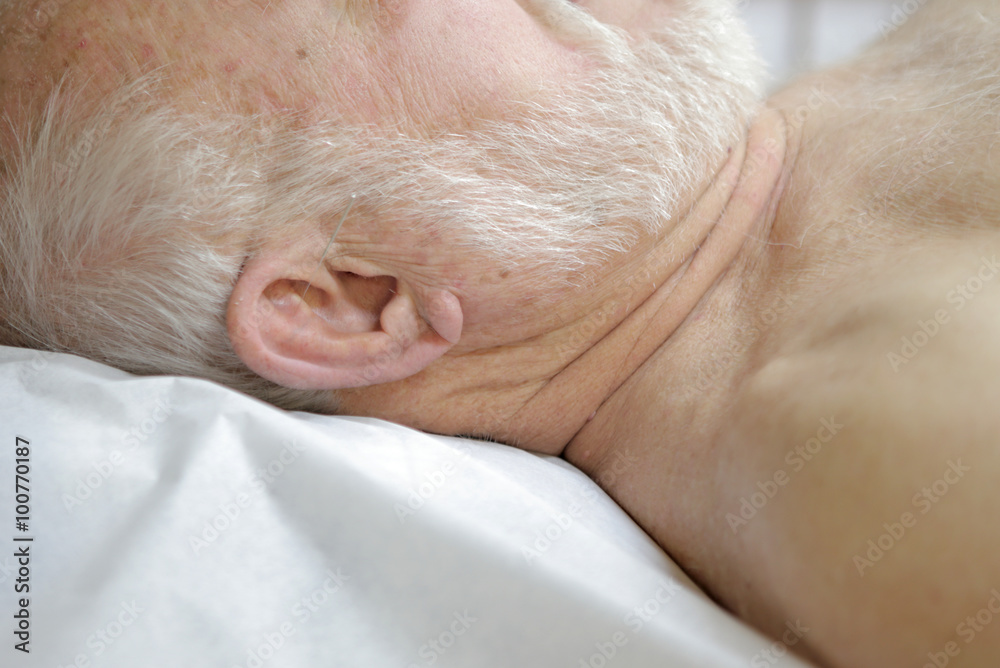 Patient with acupuncture needle in the ear.