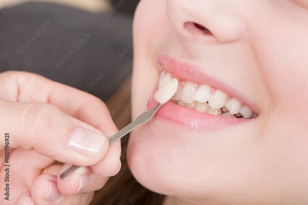 Beim Zahnarzt: Zahnfarbe für Krone vergleichen