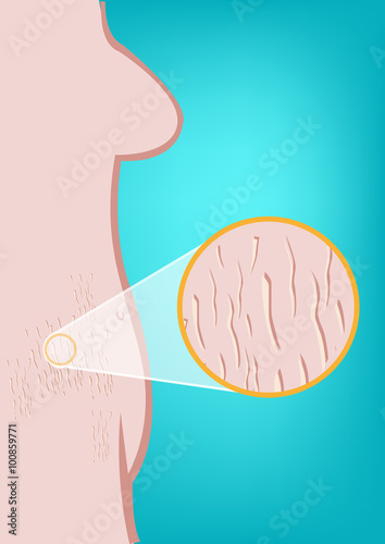 Stretch Marks or Striae Distensae skin condition zoomed in from the figure of a woman. Figure of a Woman's Body with pregnancy markings. Editable Clip Art.

