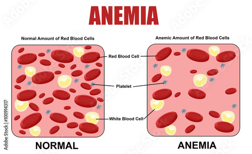 Anemia diagram, vector illustration (for basic medical education, for clinics & Schools)