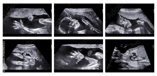 Collage of medical images of ultrasound anomaly scan