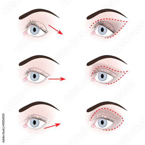 Different shapes of eyelids