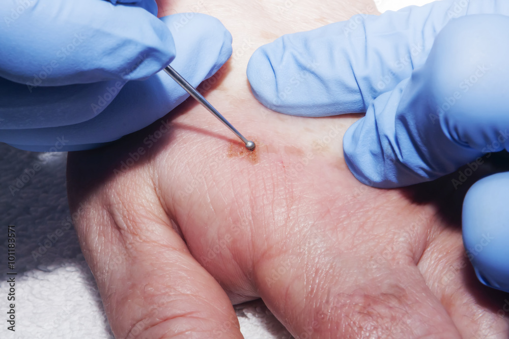 Microsurgery : Dermatologist surgeon removes skin diseases Microsurgery : Dermatologist surgeon removes skin diseases