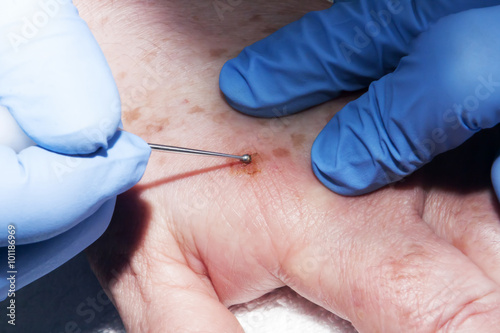 Microsurgery : Dermatologist surgeon removes skin diseases photo