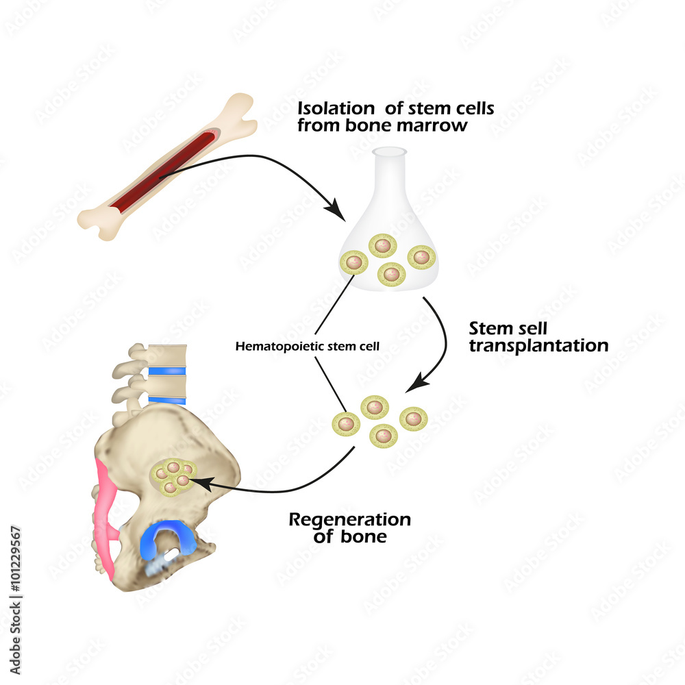 Stem cells from bone marrow are used for bone regeneration ...