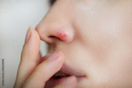Herpes on the nose - young woman with herpes on her nose