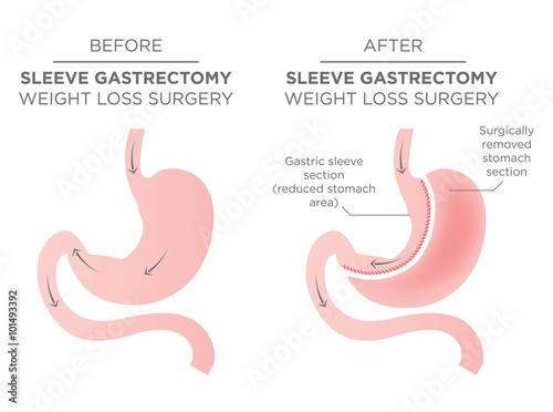 Stomach Staple Bariatric Surgery Resulting in 1/4 of the Stomach Removed.