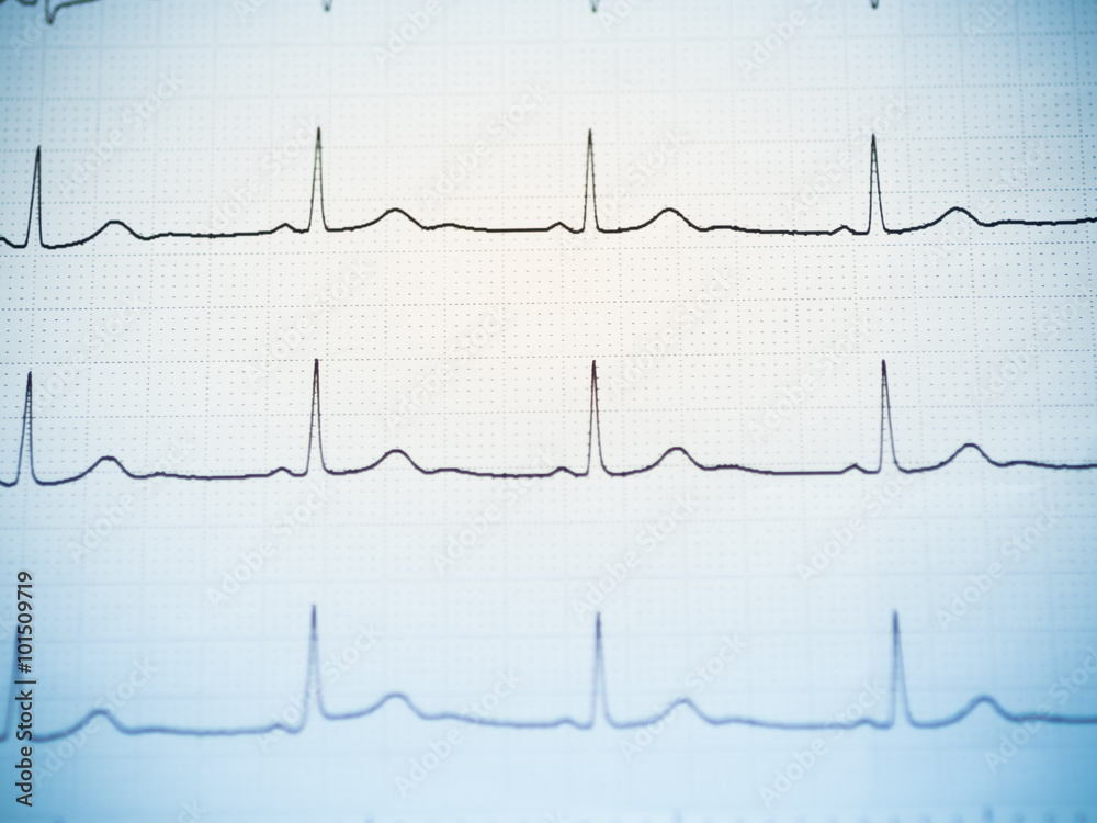 Close up of an electrocardiogram.