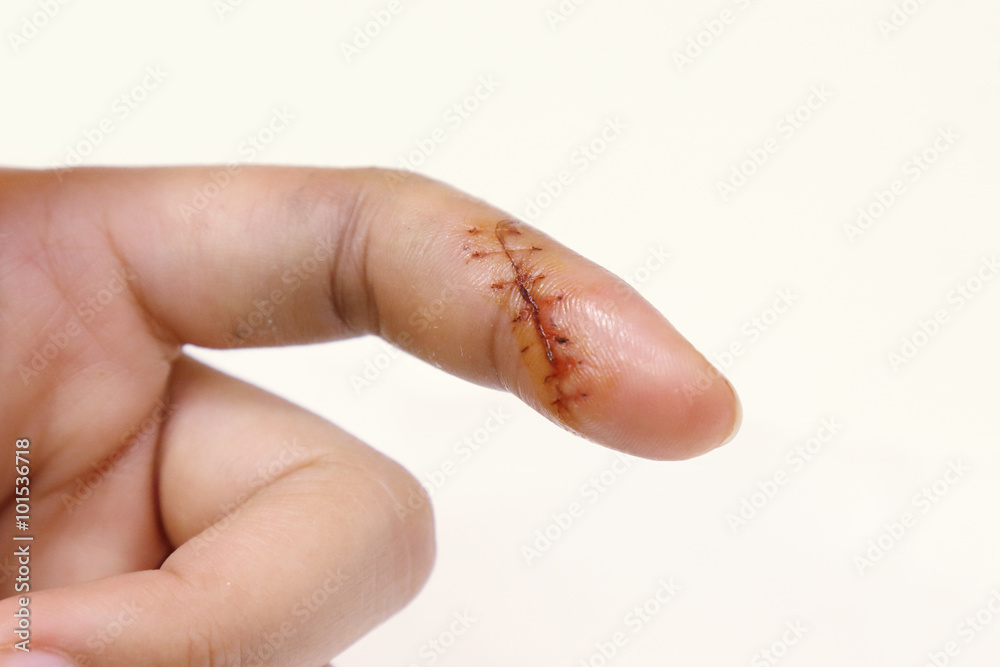 Fotografie isolated injured finger