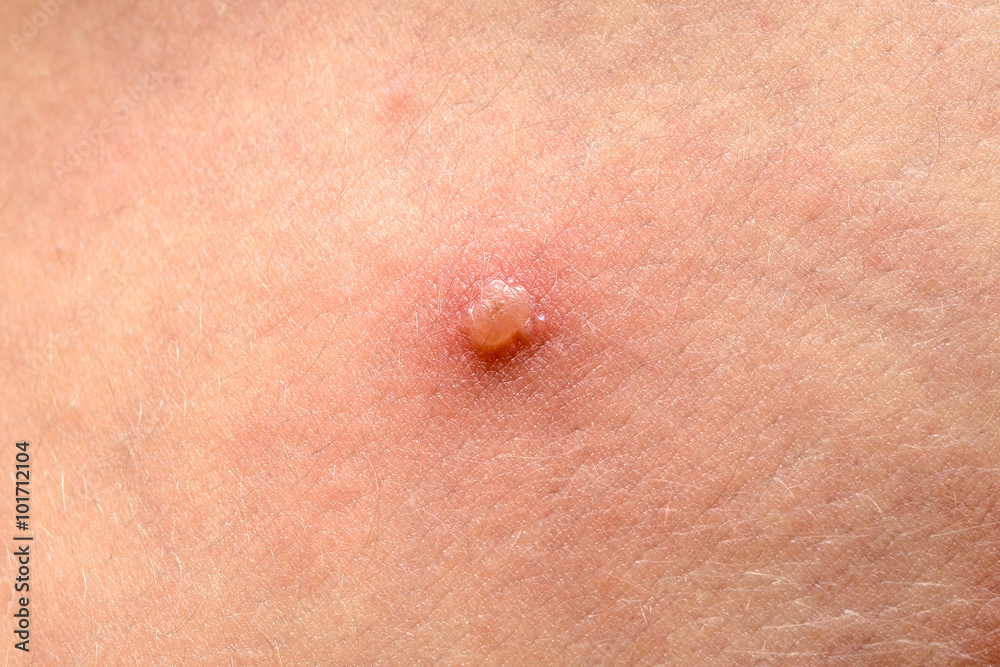 Φωτογραφία Varicella zoster virus or Chickenpox bubble rash on child, baby
