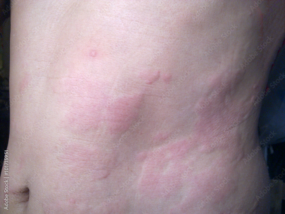 urticaria urticaria