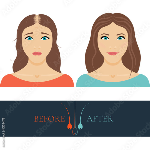 A woman losing hair before and after hair treatment and hair transplantation. Female hair loss set. Hair care concept. Hair bulb logo. Hair loss clinic concept design. Isolated vector illustration.