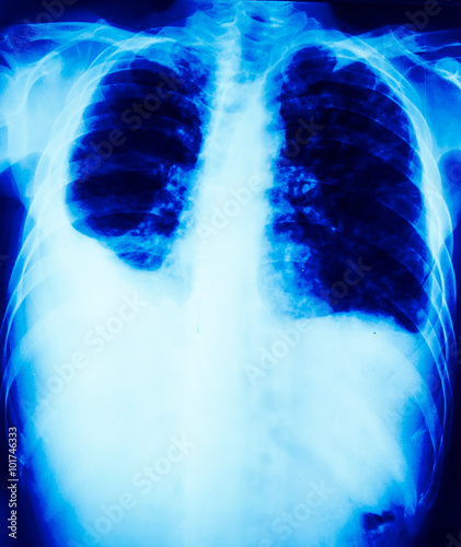 chest radiography is show pleural effusion which seen in lung disease photo